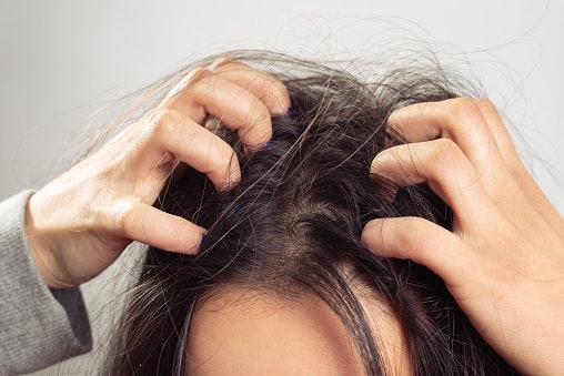 Apakah dermatitis seboroik bisa dihilangkan dengan shampo anti ketombe?