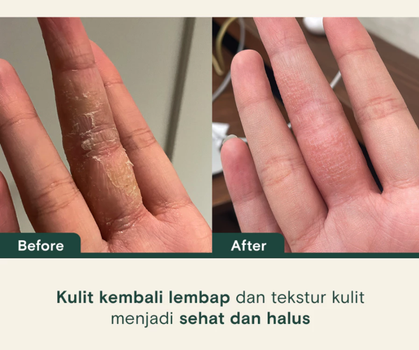 Apakah body lotion bisa melembapkan kulit kering?