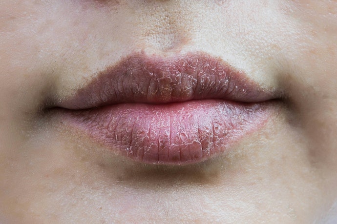 Apa penyebab bibir kering?
