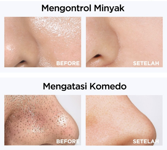 Kenapa kulit berminyak banyak komedo?