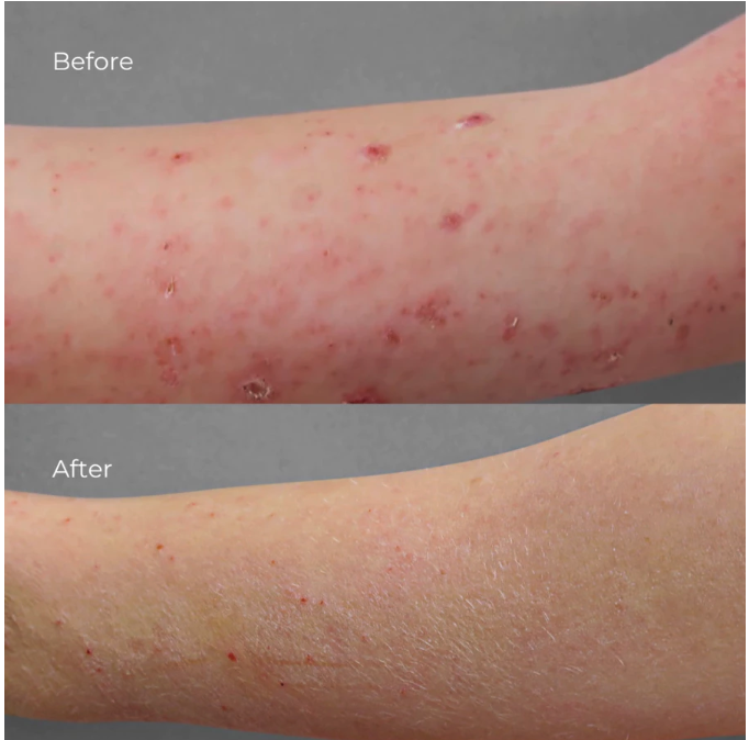 Untuk mencegah agar biang keringat tidak muncul kembali, Anda dapat menggunakan scrub seminggu sekali