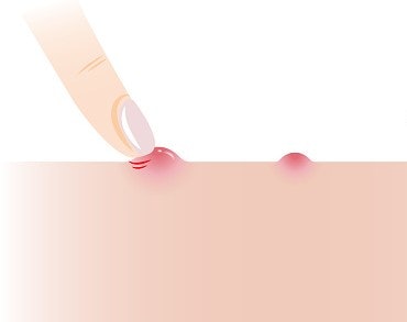 Apa penyebab munculnya bisul?