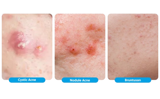 Apakah obat totol jerawat ampuh mengatasi berbagai jenis jerawat?