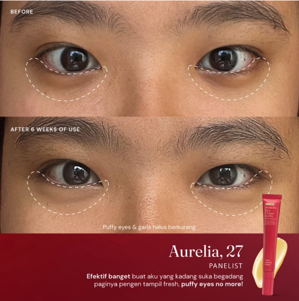 Apakah kantung mata bisa hilang dengan eye cream?