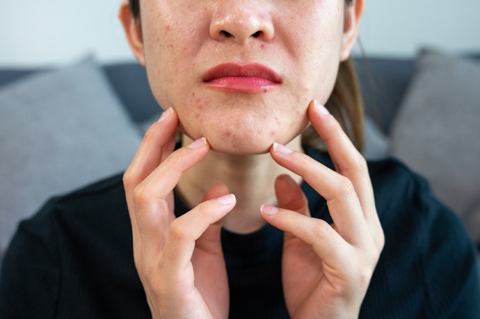 Apakah serum bisa menghilangkan bekas jerawat?