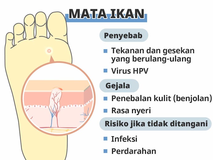 Apa itu mata ikan?