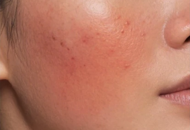 Apa tanda skin barrier yang rusak?