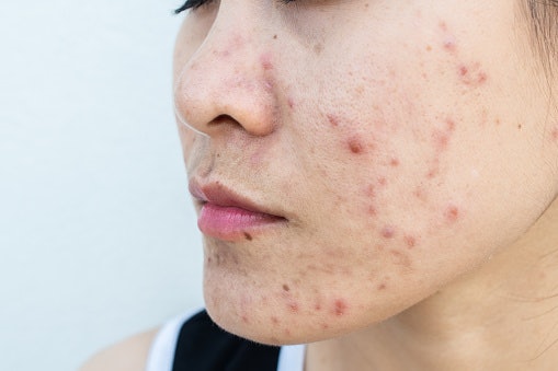 Kulit berjerawat, BB cream dengan pigmentasi yang baik dapat samarkan jerawat