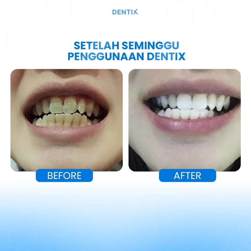 DENTIX Teeth Whitening Expert 5