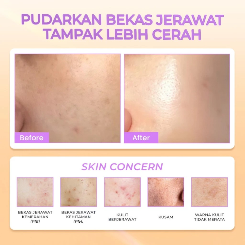 Power Post Acne Serum 3