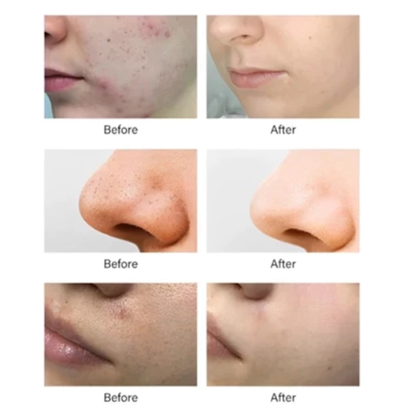 Azelaic Acid Suspension 10% 4