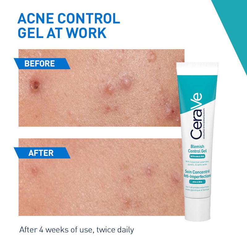 Blemish Control Gel 4