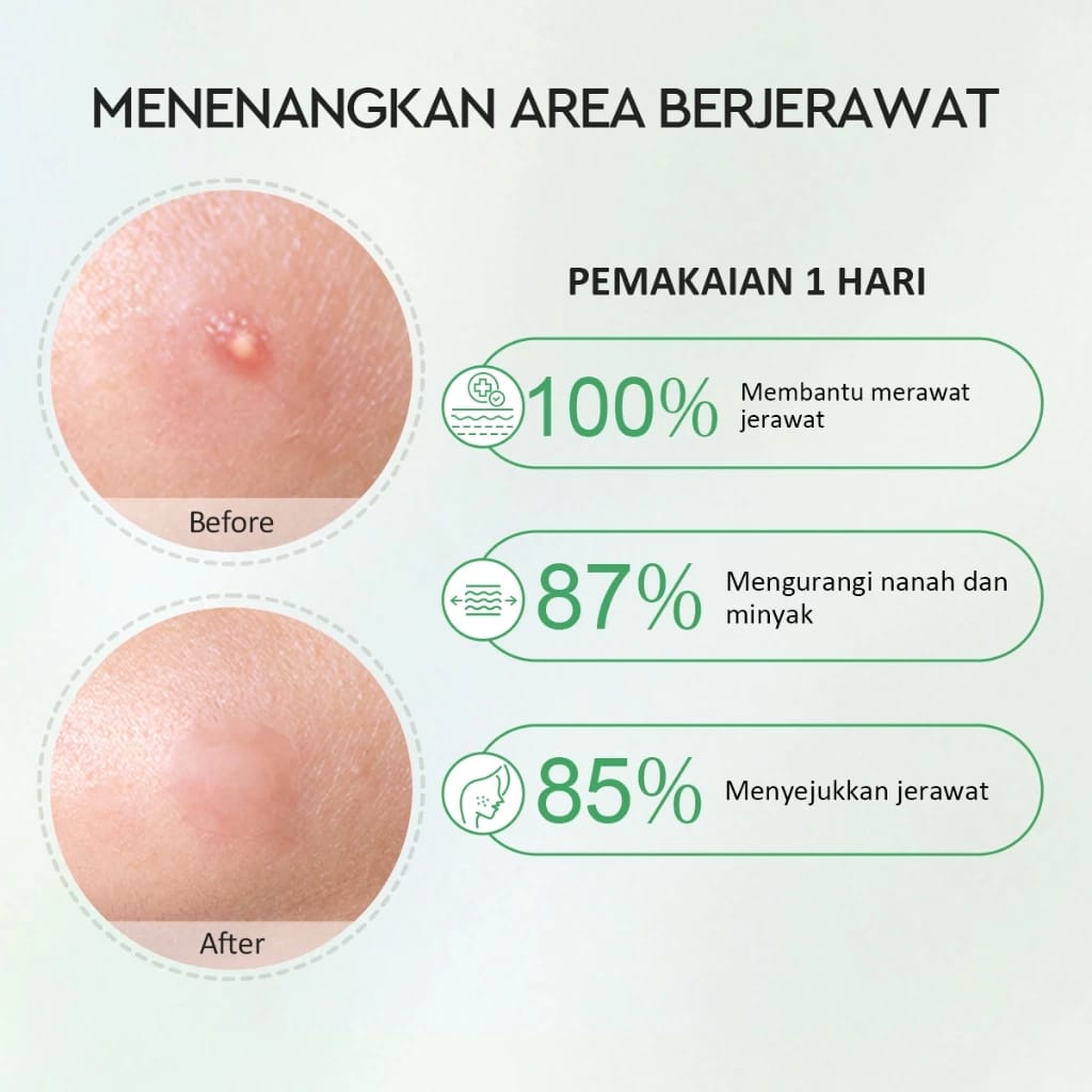  Suntone Wisdom Indonesia Glad2Glow Centella Salicylic Night Acne Patch