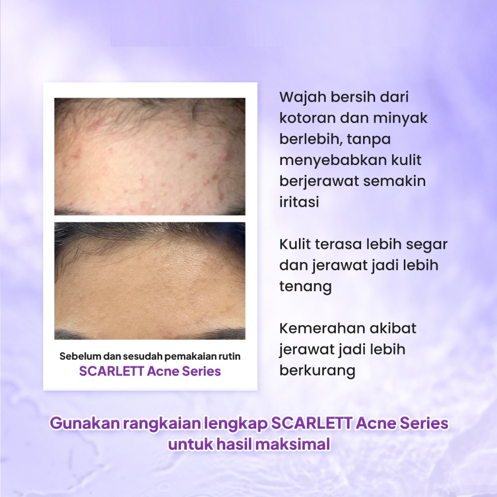 Opto Lingkar Sejahtera Scarlett Whitening Acne Facial Wash