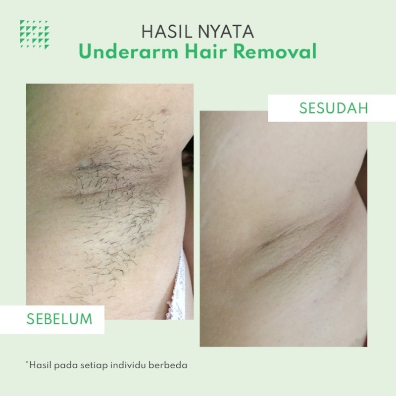 ZAP Clinic Voucher Underarm Hair Removal 3