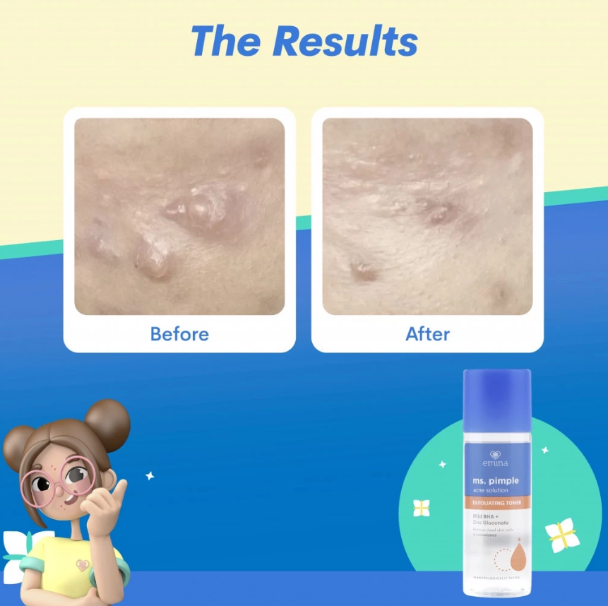 Paragon Technology and Innovation Emina Ms. Pimple Acne Solution Exfoliating Toner