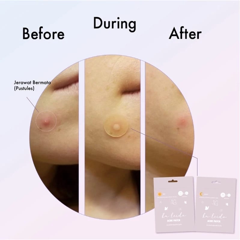 Kaleido Kosmetik Internasional Kaleido Acne Patch Night