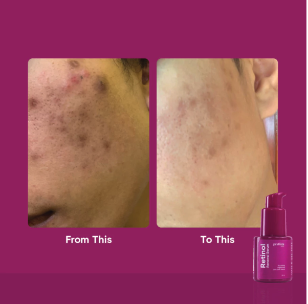 Pratista Citra Nusantara Pratista Retinol Renewal Serum