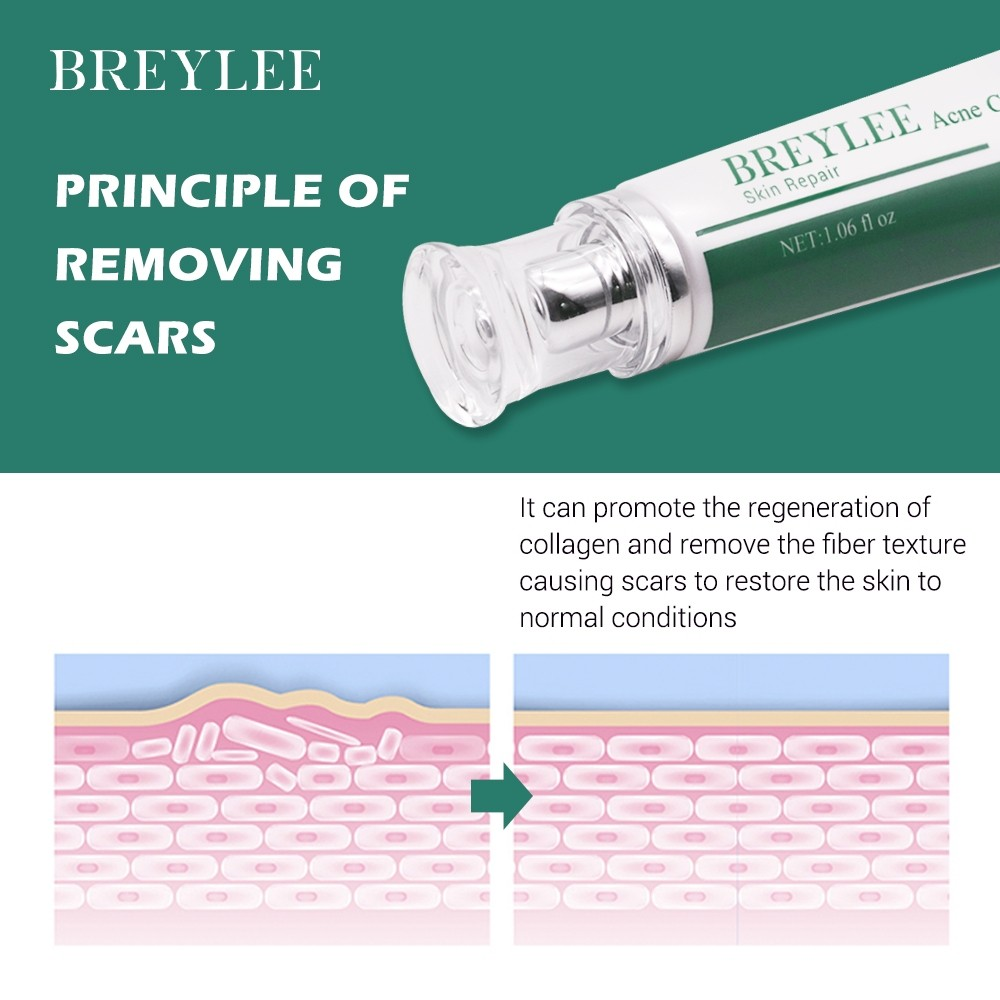  BREYLEE Acne Scar Removal