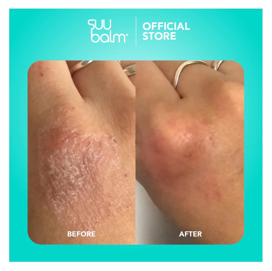 Good Pharma Dermatology Suu Balm Ceramide Moisturiser Rapid Itch Relief