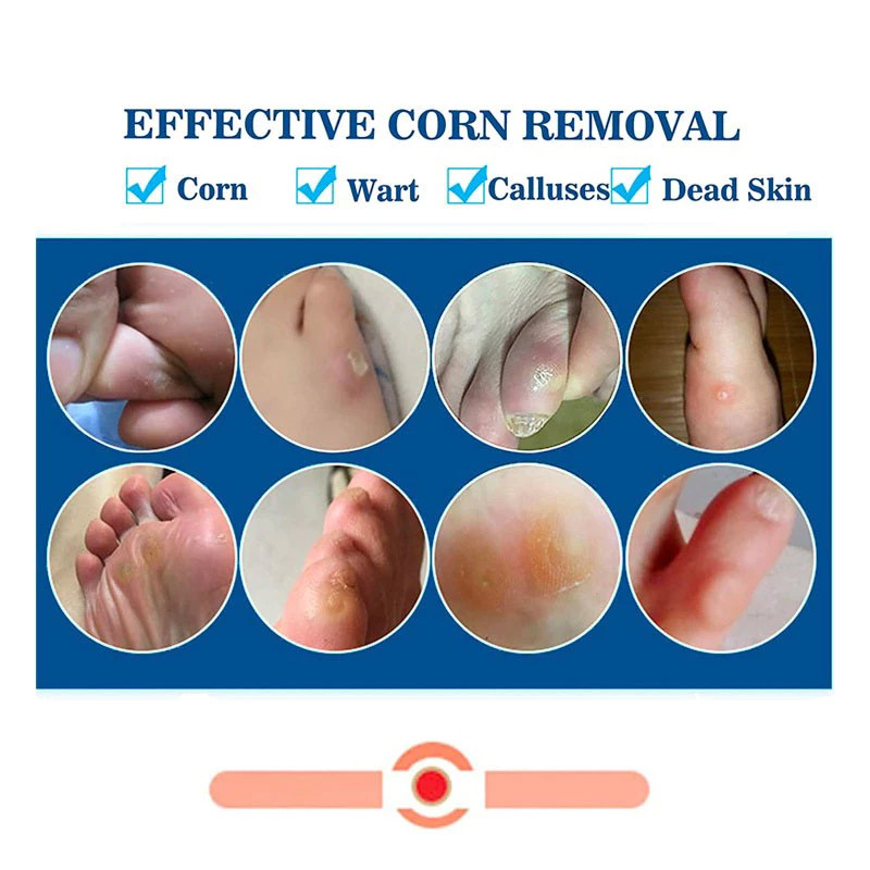 Eraycee Corn Removal Pads