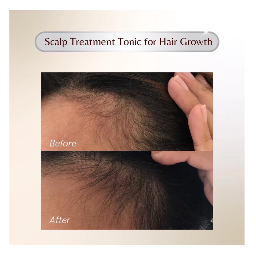 Transmedic Indonesia Everlaskin Scalp Treatment Hair Tonic