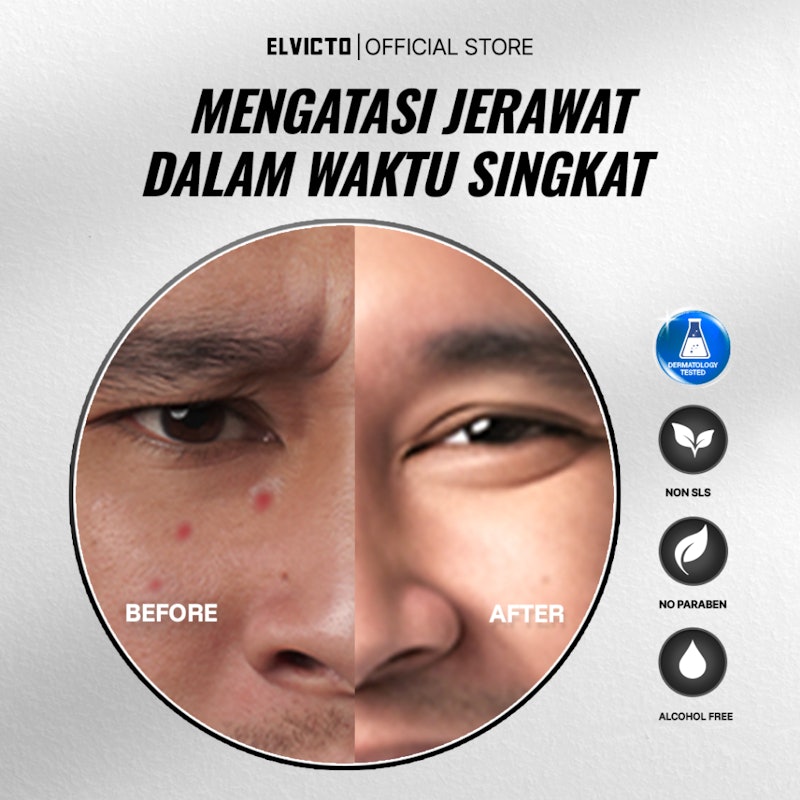 Men Acne Toner 4