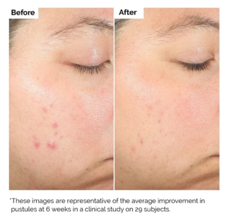 Salicylic Acid 2% Solution 4