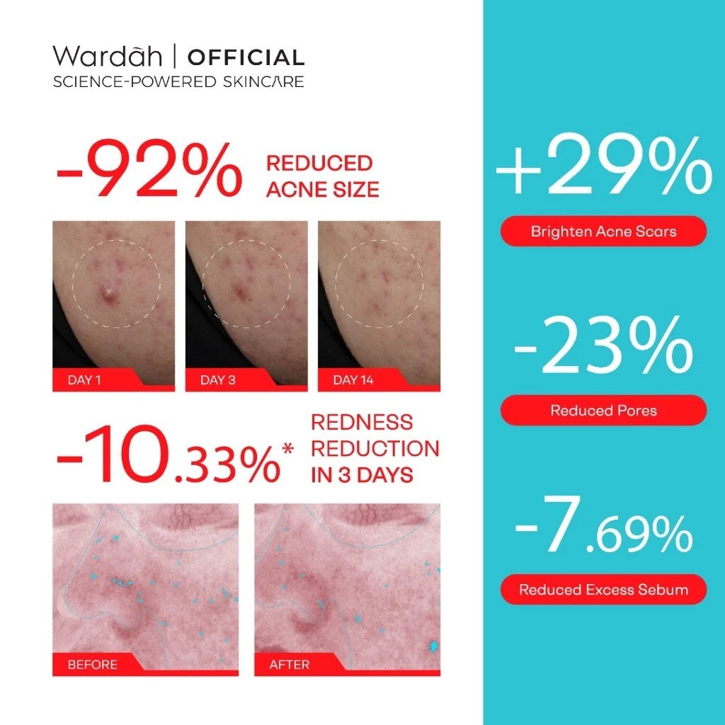 Acnederm + AZ + SA Acne Relief Serum 5