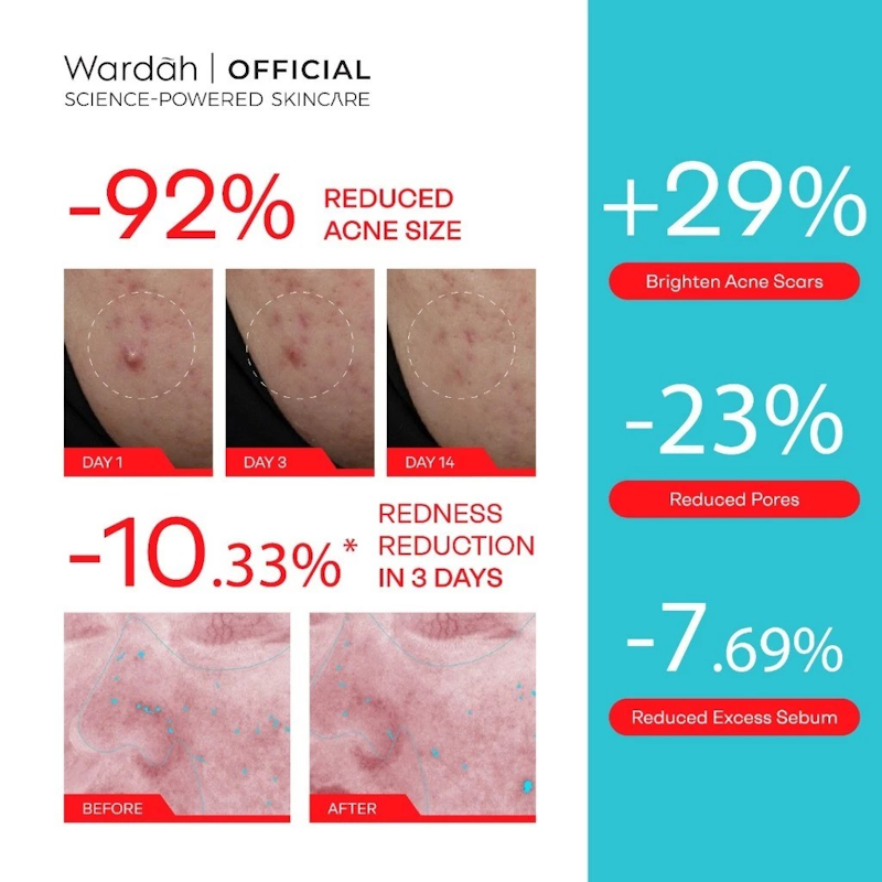 Acnederm + AZ + SA Acne Relief Serum 5
