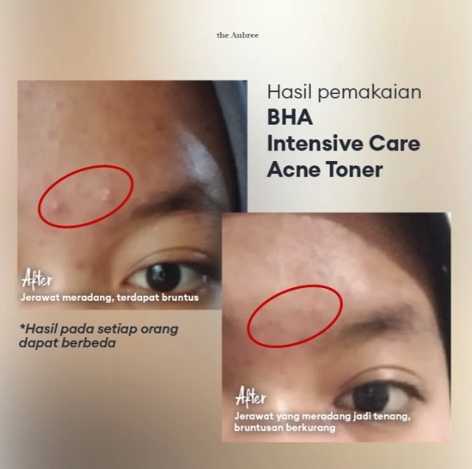 Aubree Asia Botanika The Aubree BHA Intensive Acne Toner 