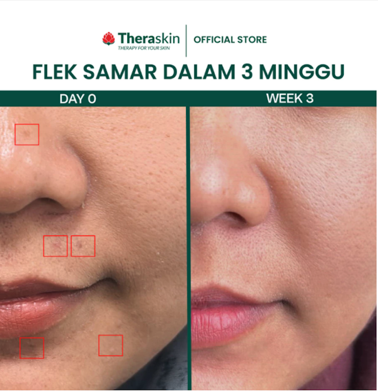 Theraskin AHA 10 Cream 5