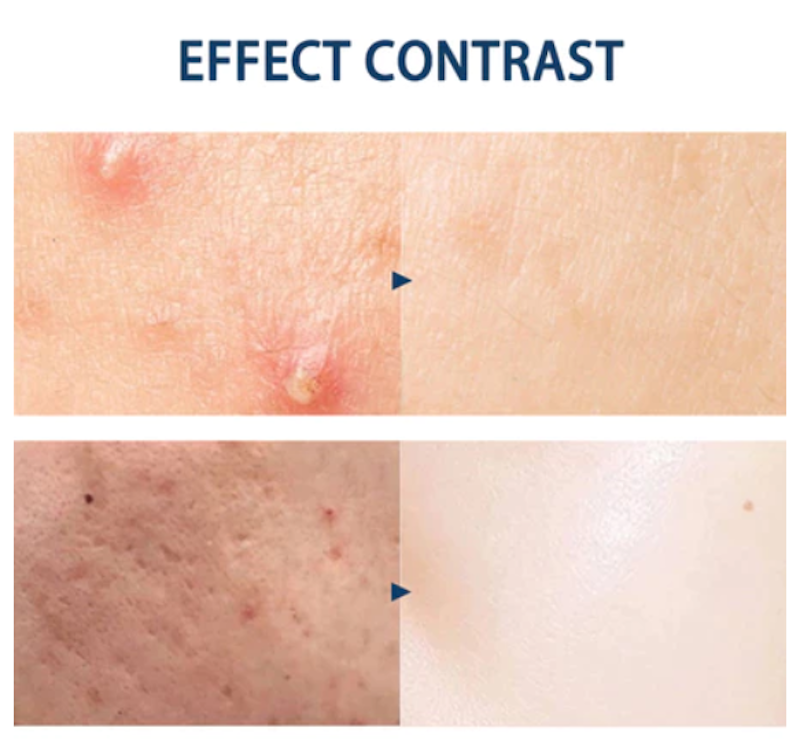 Azelaic Acid Suspension 10% 5