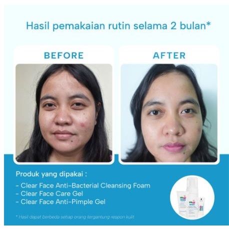 Sebapharm Sebamed Clear Face Anti Pimple Gel 