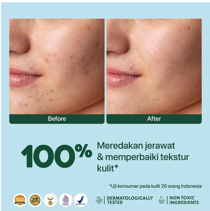 Penta Natural Kosmetindo N'PURE Centella Asiatica Acne Clear Advanced Biome