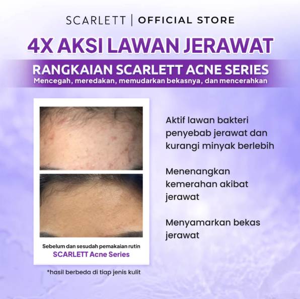 Opto Lingkar Sejahtera Scarlett Whitening Acne Series Package