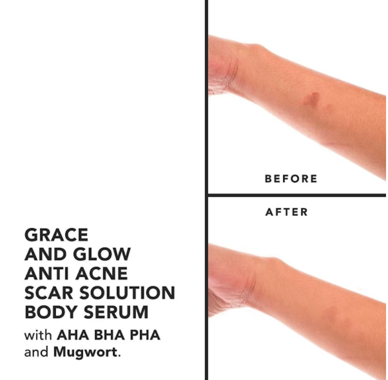 Grace and Glow English Pear and Freesia Anti Acne & Scar Solution Body Serum 3