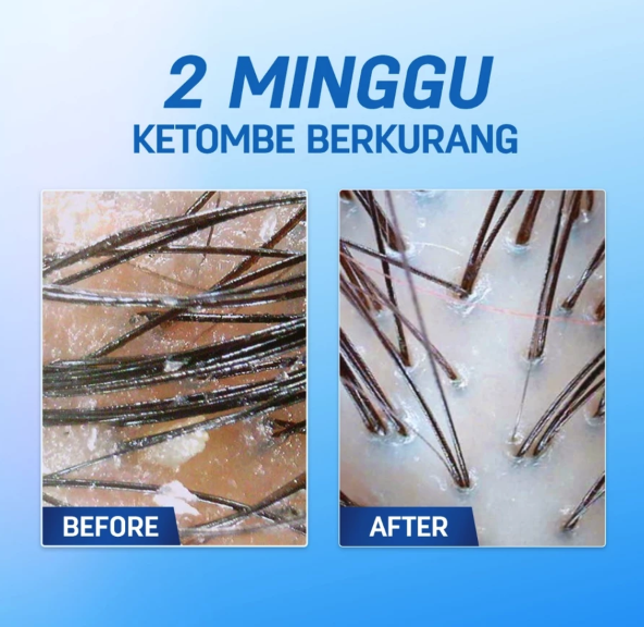 ERHA Clinic Indonesia Erhair Scalperfect Piroctone Olamine & Climbazole Anti Dandruff Shampoo
