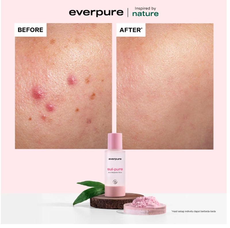 Sul-pure Acne Suspension Toner 4