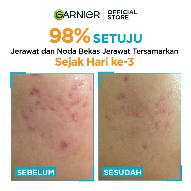 Bright Complete Anti Acne Serum 4