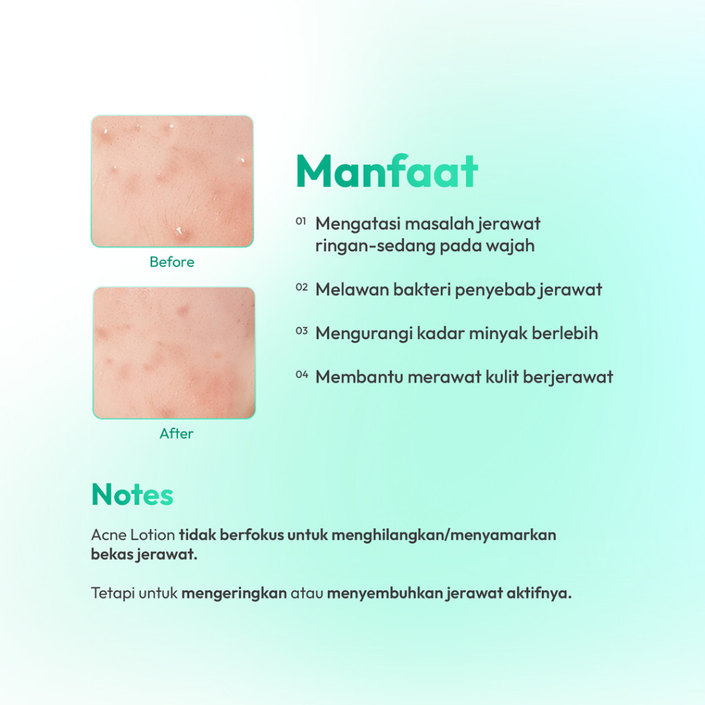 Larissa Acne Lotion