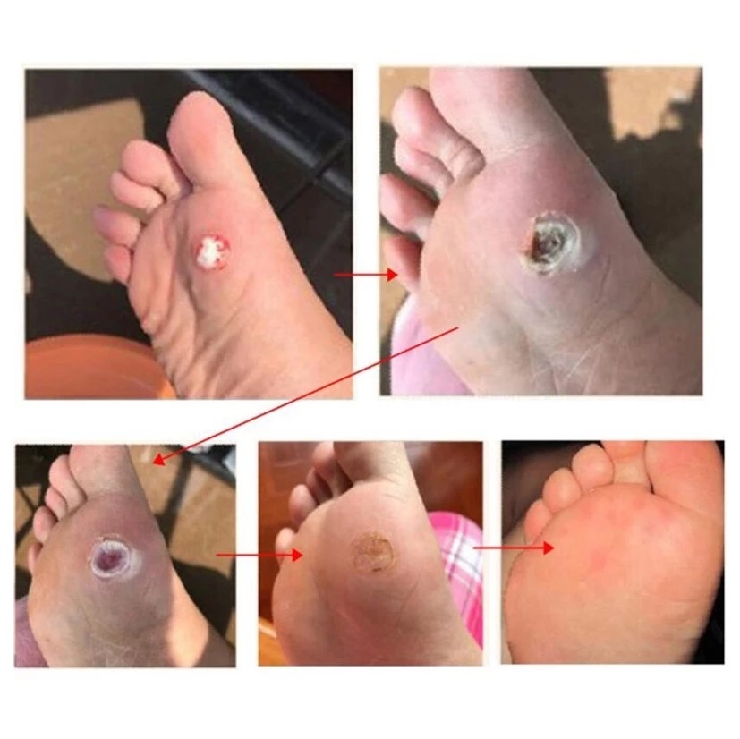  SWEETRIP Plester Mata Ikan