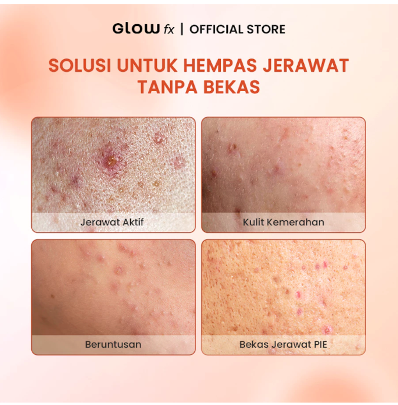 GLOW fx BEAUTY Acne Pure Serum 4