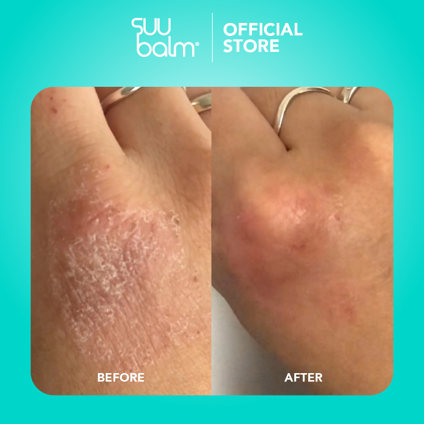 Good Pharma Dermatology Suu Balm Ceramide Moisturiser Rapid Itch Relief