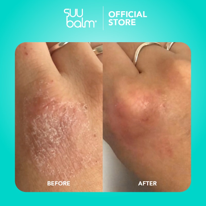 Suu Balm Ceramide Moisturiser Rapid Itch Relief 5