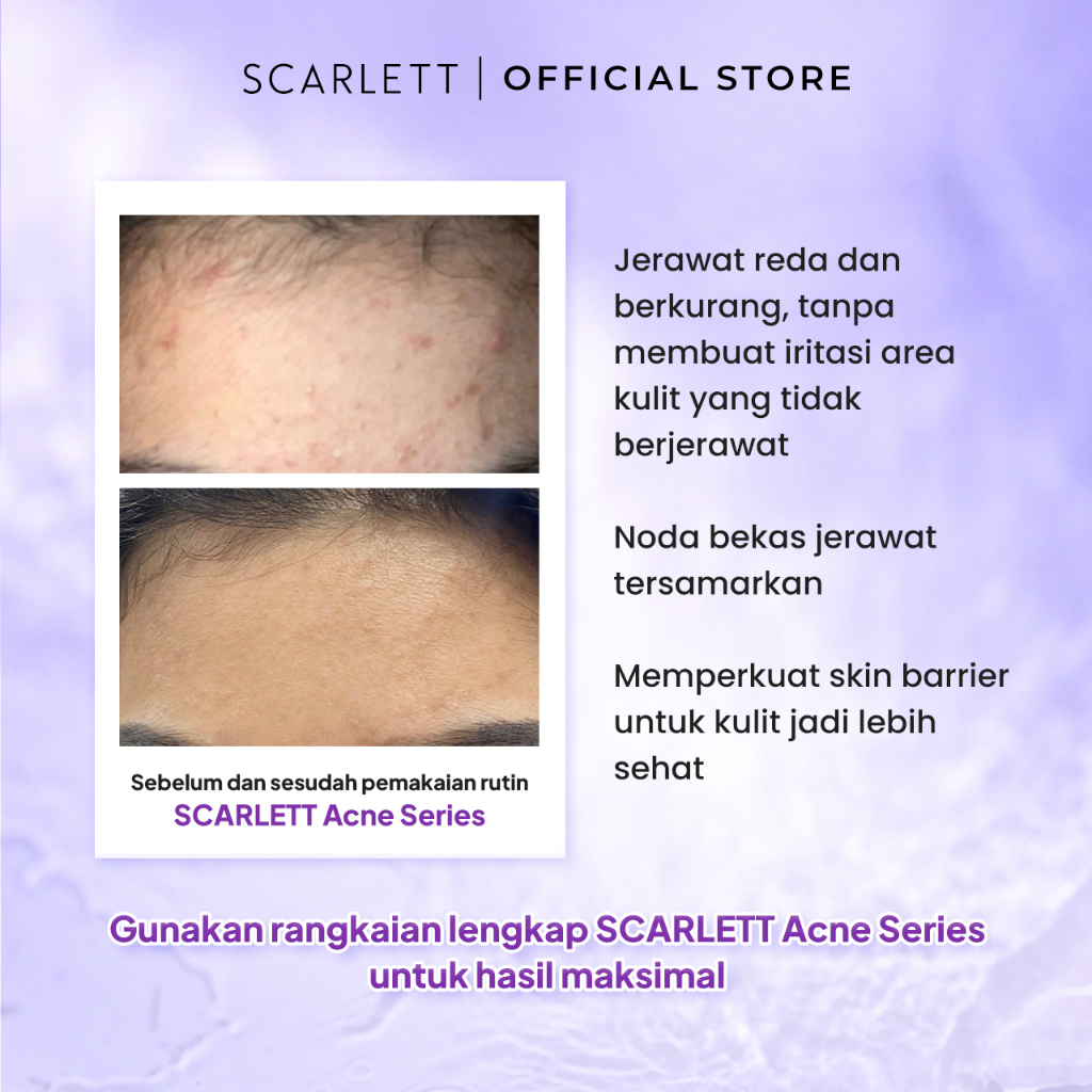 Opto Lingkar Sejahtera Scarlett Whitening Acne Serum