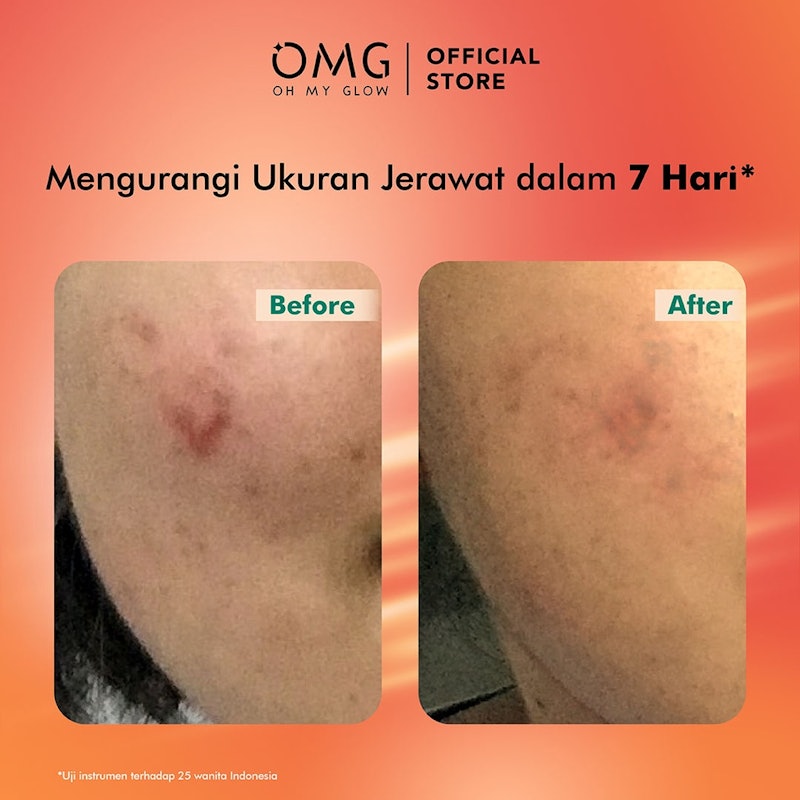 Mugwort Acne Serum 4