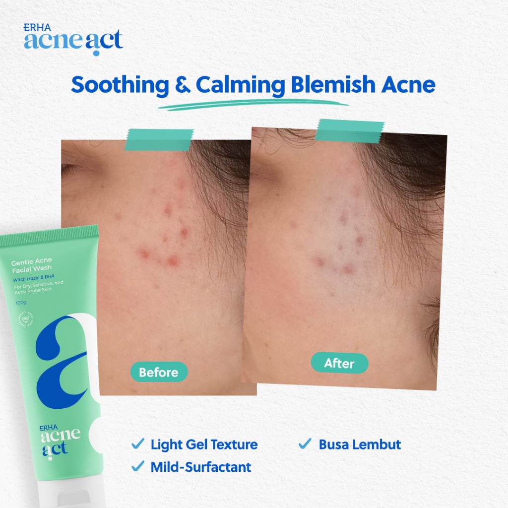 ERHA Clinic Indonesia AcneAct Witch Hazel & BHA Gentle Acne Facial Wash