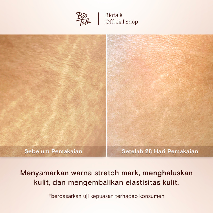 Bionatura Berkat Abadi BioTalk Stretch Mark Oil