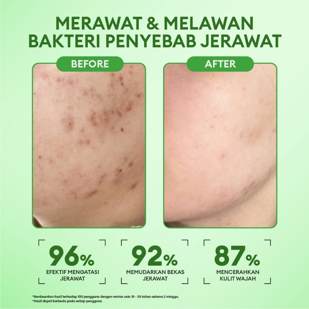 Pesona Estetika Internasional Animate Intense Acne Solution Night Cream